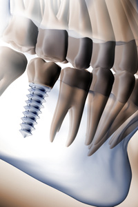 Zahnimplantologie